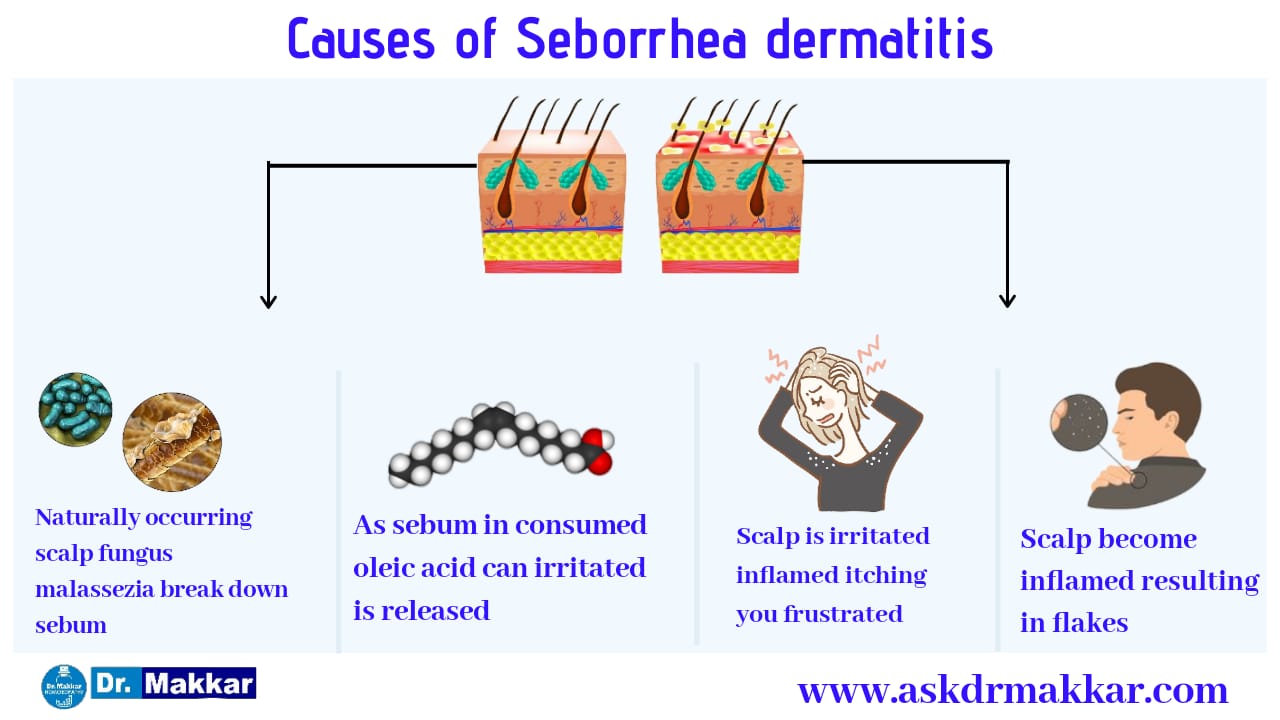 Seborrheic Dermatitis Symptoms Causes And Other Risk Factors Porn Sex Picture